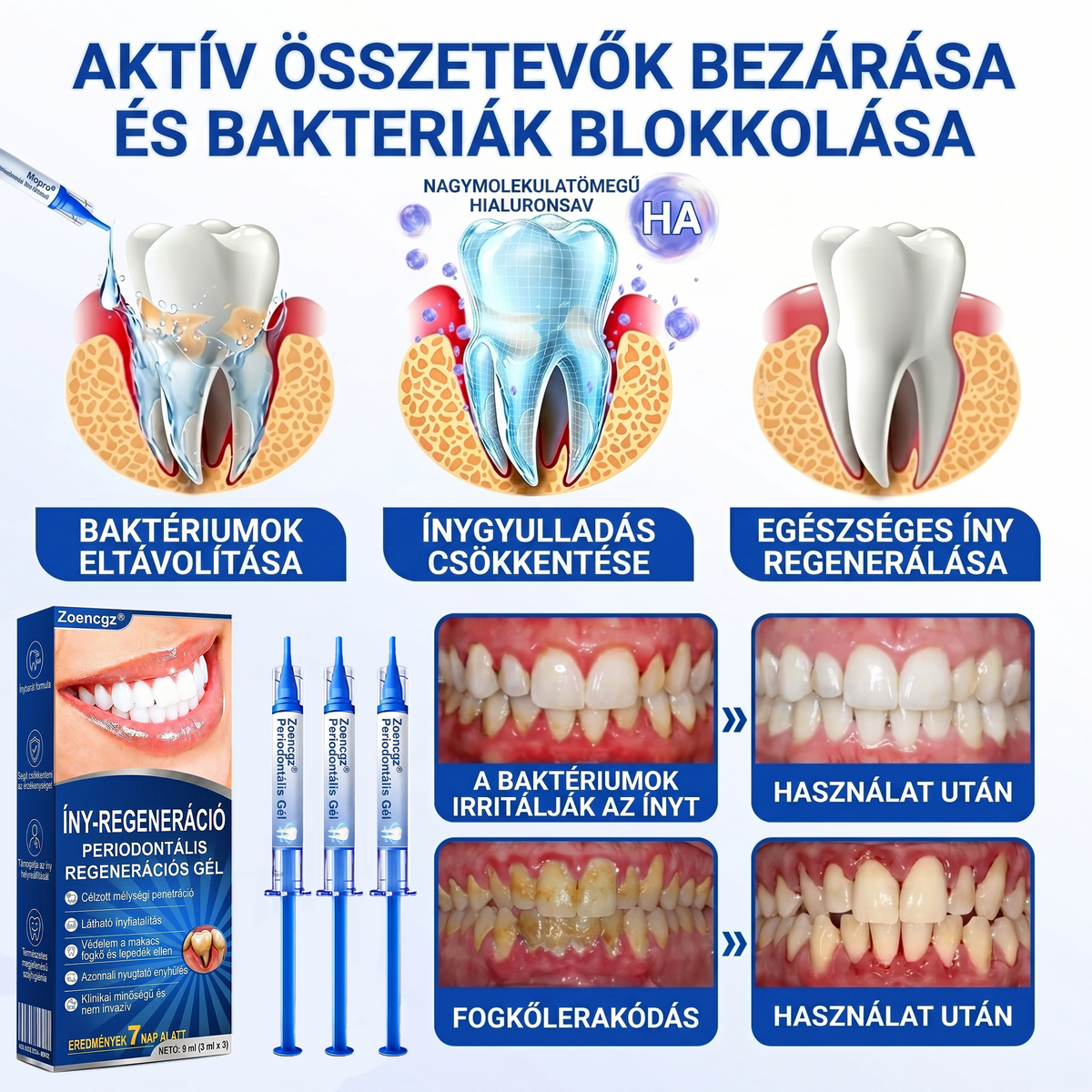 Zoencgz®🦷🔋 Antibakteriális ínyregeneráló gél | Látható eredmények már 7 nap alatt