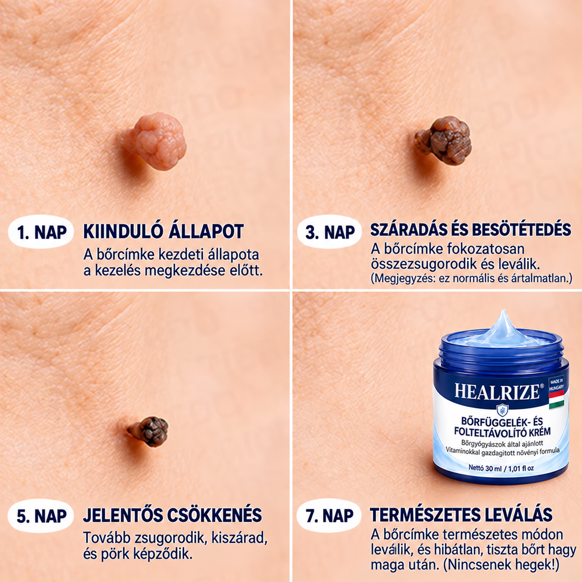 𝐇𝐞𝐚𝐥𝐫𝐢𝐳𝐞®🍄8️⃣ 7 napos krém bőrkinövések és pigmentfoltok ellen (fájdalommentes formula – hegmentes)🌿