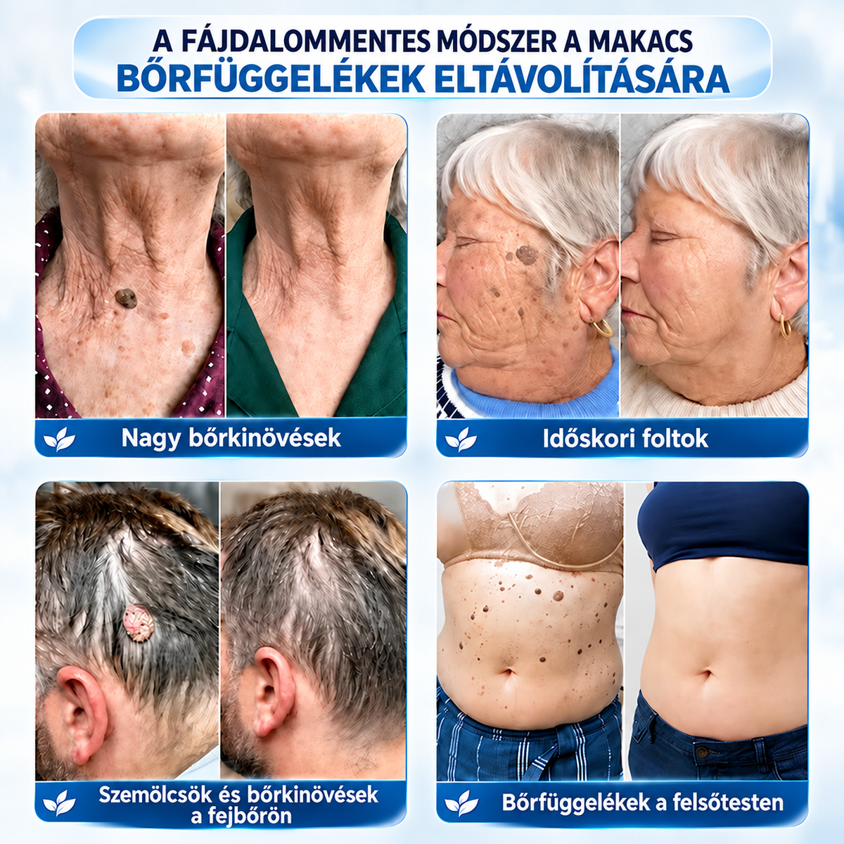 𝐇𝐞𝐚𝐥𝐫𝐢𝐳𝐞®🍄8️⃣ 7 napos krém bőrkinövések és pigmentfoltok ellen (fájdalommentes formula – hegmentes)🌿