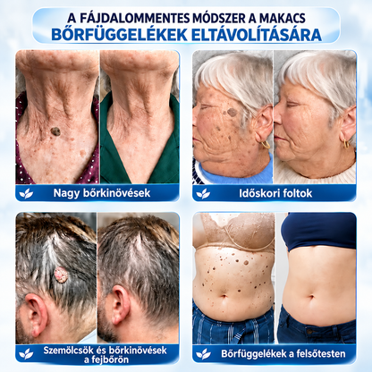 𝐇𝐞𝐚𝐥𝐫𝐢𝐳𝐞®🍄8️⃣ 7 napos krém bőrkinövések és pigmentfoltok ellen (fájdalommentes formula – hegmentes)🌿