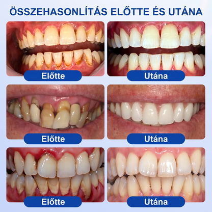 Zoencgz®🦷🔋 Antibakteriális ínyregeneráló gél | Látható eredmények már 7 nap alatt